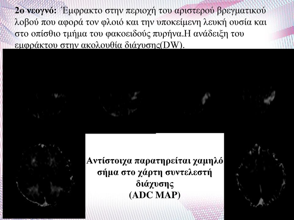 φακοειδούς πυρήνα.η ανάδειξη του εμφράκτου στην ακολουθία διάχυσης(dw).