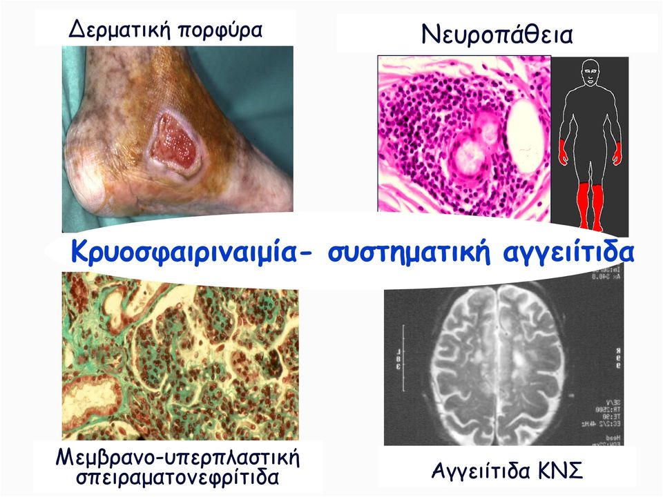 αγγειίτιδα