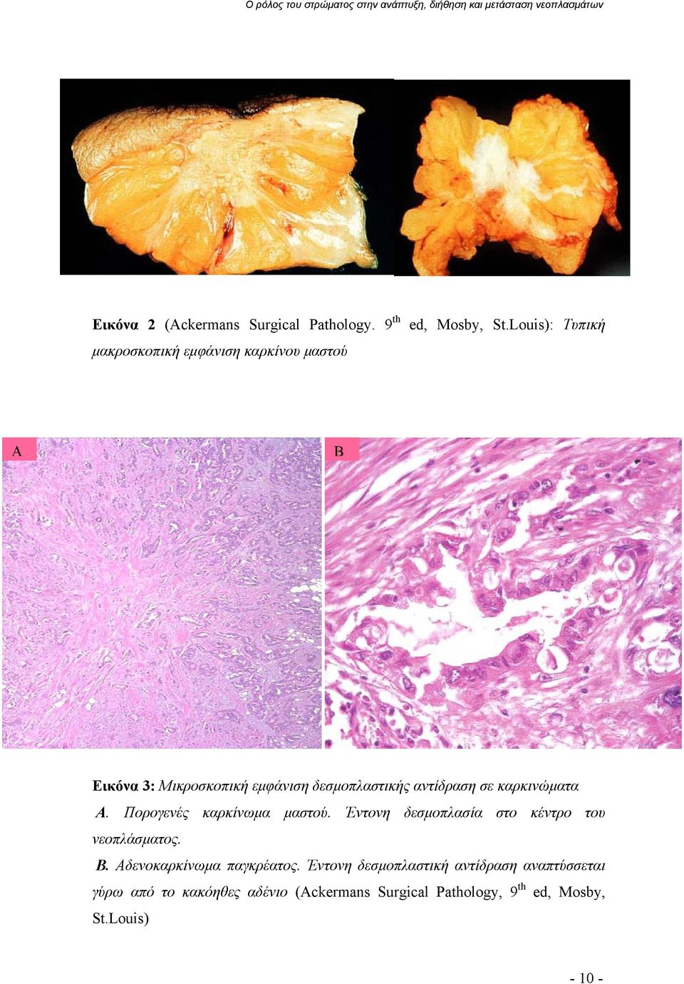 Πορογενές καρκίνωμα μαστού. Έντονη δεσμοπλασία στο κέντρο του νεοπλάσματος. Β. Αδενοκαρκίνωμα παγκρέατος.
