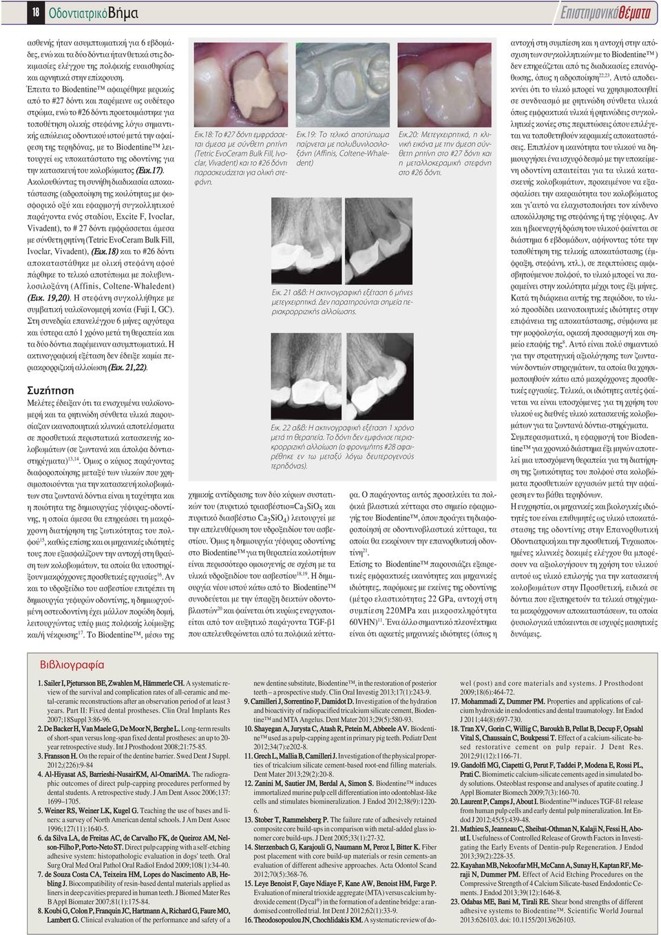 την αφαίρεση της τερηδόνας, με το Biodentine λειτουργεί ως υποκατάστατο της οδοντίνης για την κατασκευή του κολοβώματος (Εικ.17).