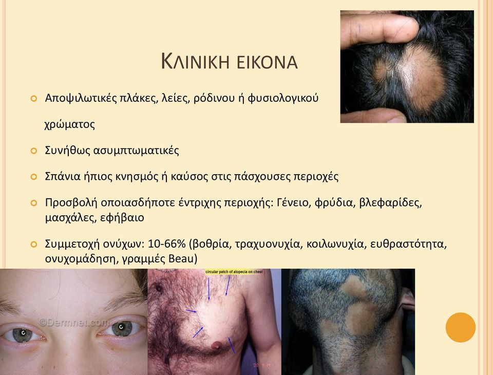 οποιαςδιποτε ζντριχθσ περιοχισ: Γζνειο, φρφδια, βλεφαρίδεσ, μαςχάλεσ, εφιβαιο