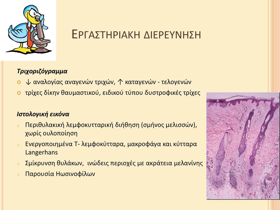 λεμφοκυτταρικι διικθςθ (ςμινοσ μελιςςϊν), χωρίσ ουλοποίθςθ Ενεργοποιθμζνα Σ- λεμφοκφτταρα,