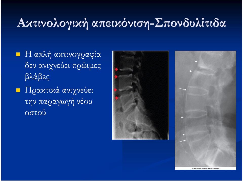 ακτινογραφία δεν ανιχνεύει