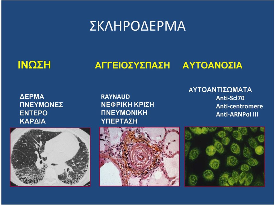 ΝΕΦΡΙΚΗ ΚΡΙΣΗ ΠΝΕΥΜΟΝΙΚΗ ΥΠΕΡΤΑΣΗ