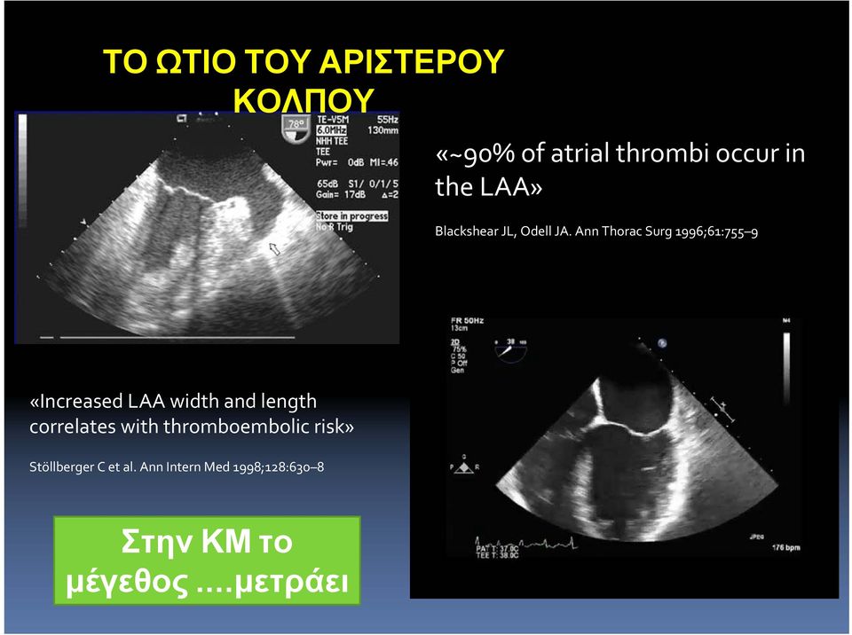 Ann Thorac Surg 1996;61:755 9 «Increased LAA width and length