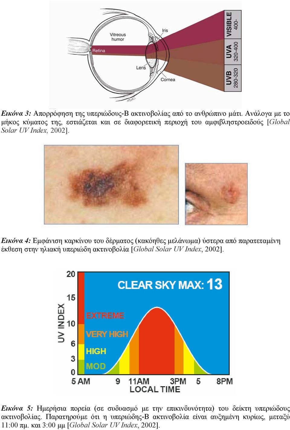 Εικόνα 4: Εµφάνιση καρκίνου του δέρµατος (κακόηθες µελάνωµα) ύστερα από παρατεταµένη έκθεση στην ηλιακή υπεριώδη ακτινοβολία [Global Solar UV
