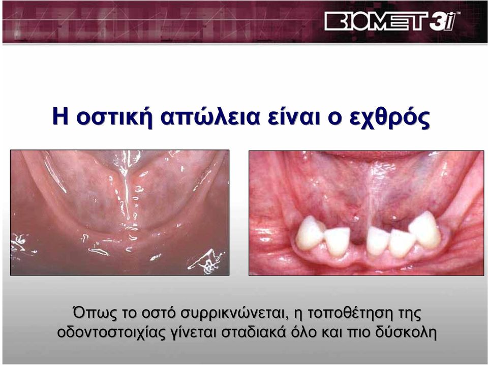τοποθέτηση της οδοντοστοιχίας