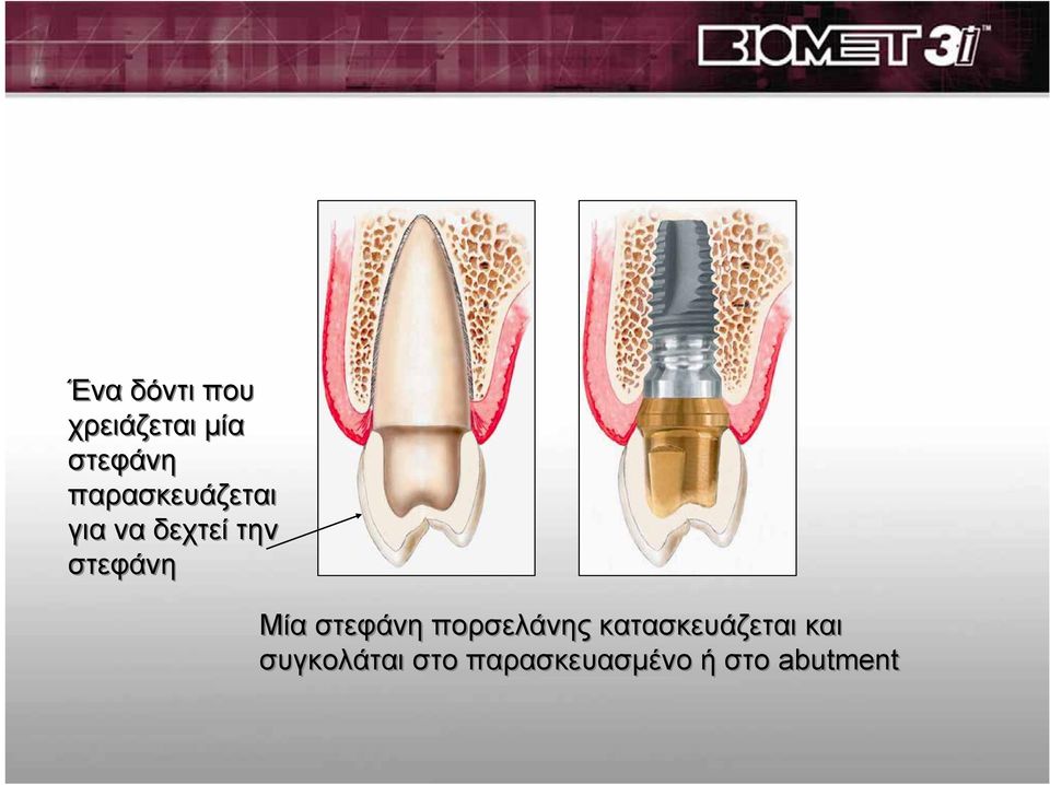 Μία στεφάνη πορσελάνης κατασκευάζεται