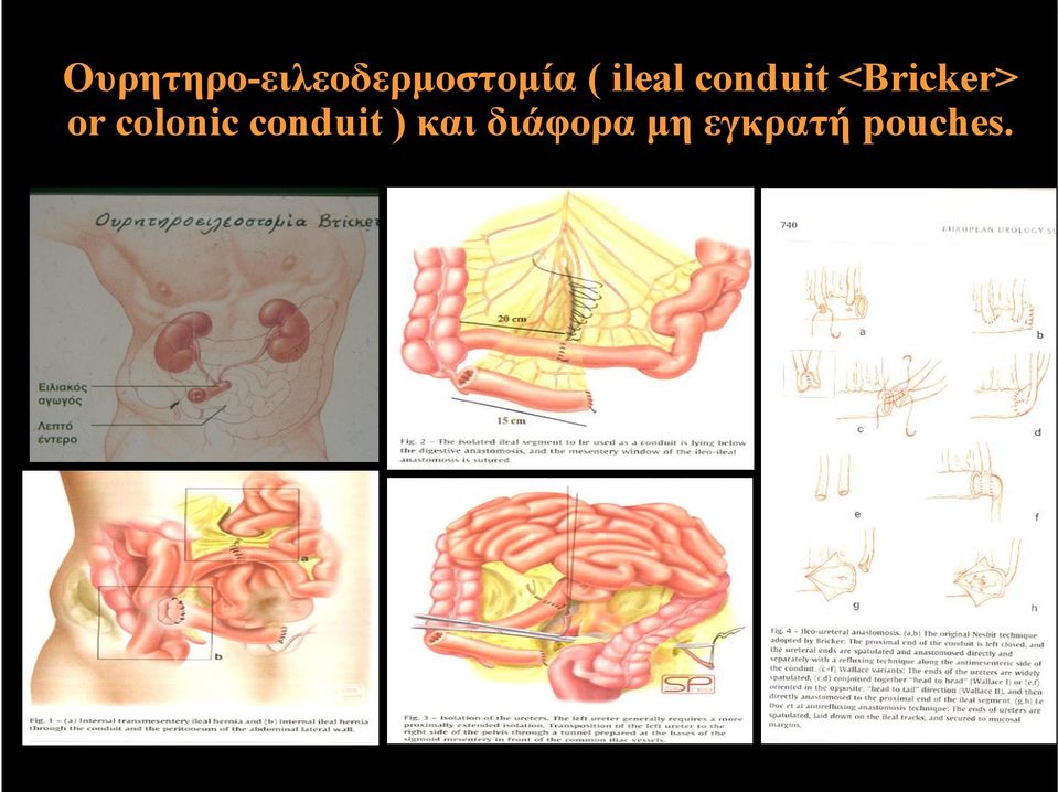 or colonic conduit ) και