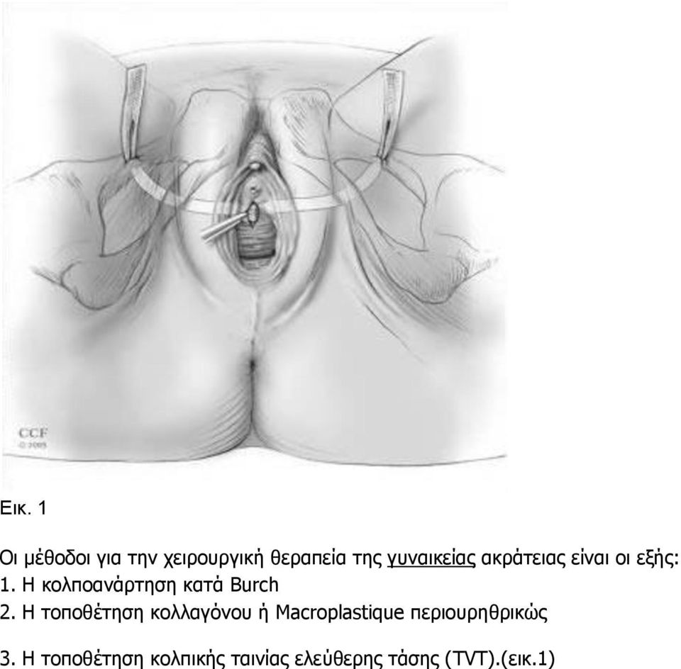 Η κολποανάρτηση κατά Burch 2.