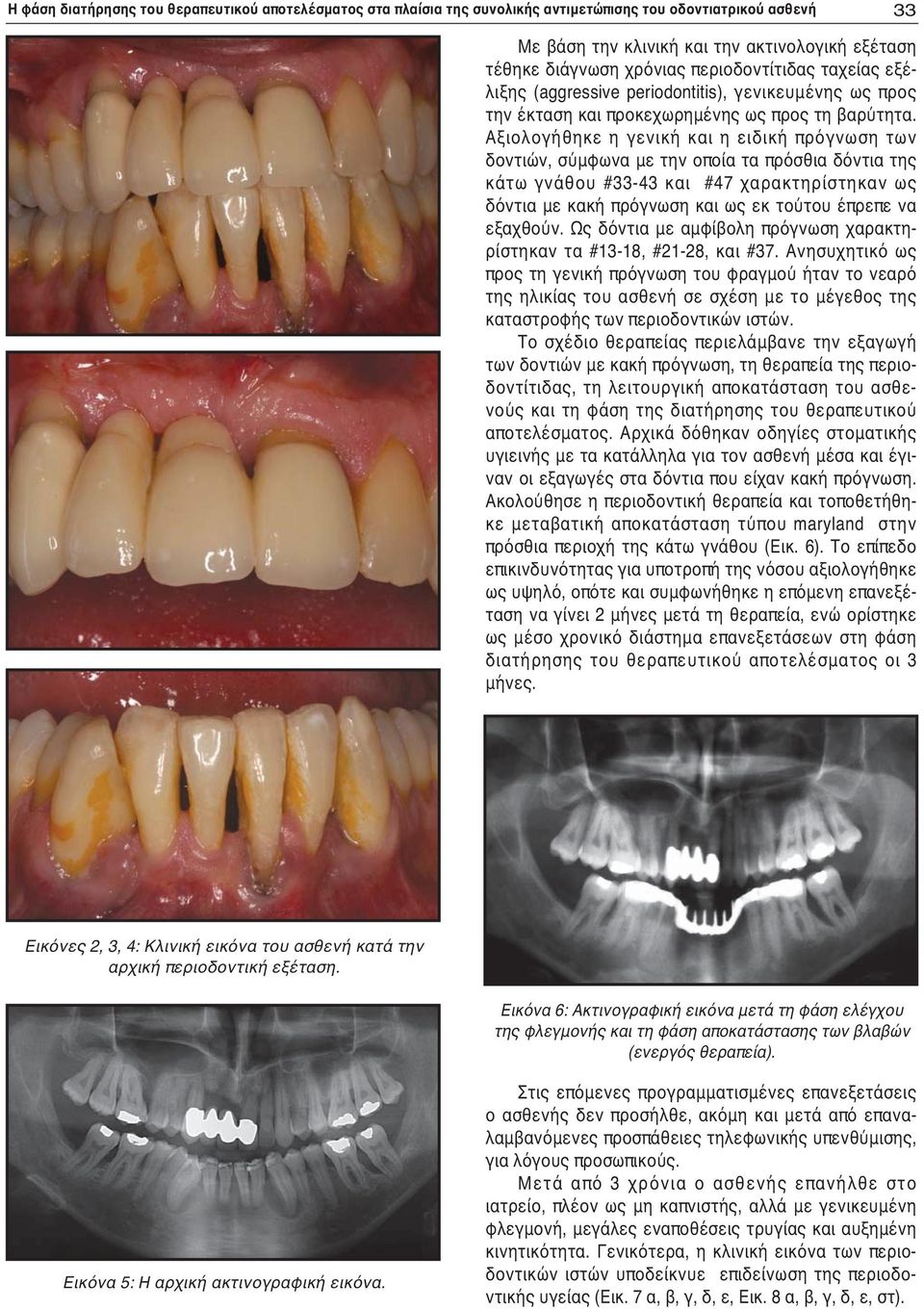 Αξιολογήθηκε η γενική και η ειδική πρόγνωση των δοντιών, σύμφωνα με την οποία τα πρόσθια δόντια της κάτω γνάθου #33-43 και #47 χαρακτηρίστηκαν ως δόντια με κακή πρόγνωση και ως εκ τούτου έπρεπε να