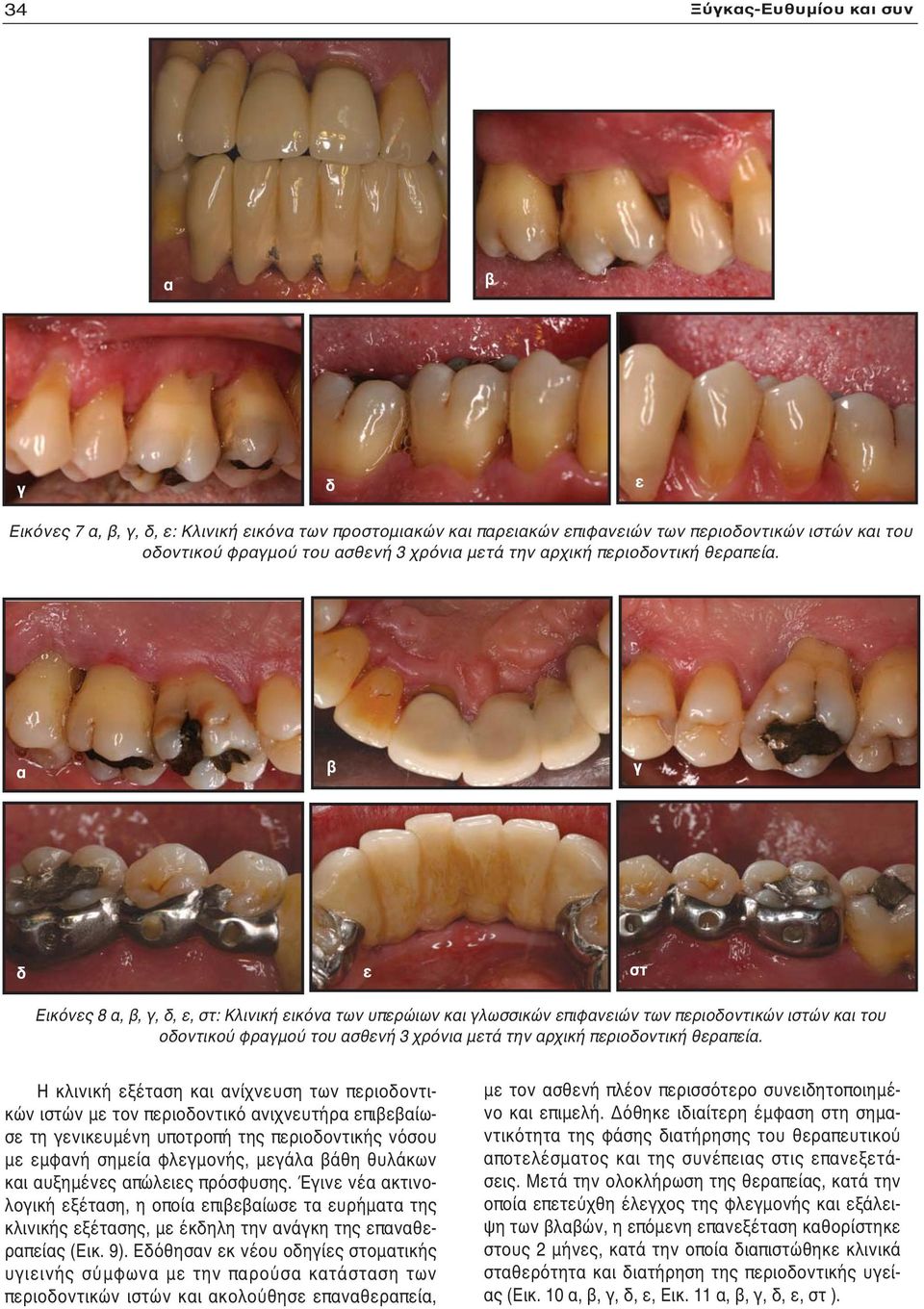 α β γ δ ε στ Εικόνες 8 α, β, γ, δ, ε, στ: Κλινική εικόνα των υπερώιων και γλωσσικών επιφανειών των περιοδοντικών ιστών και του οδοντικού φραγμού του ασθενή 3 χρόνια μετά την  Η κλινική εξέταση και