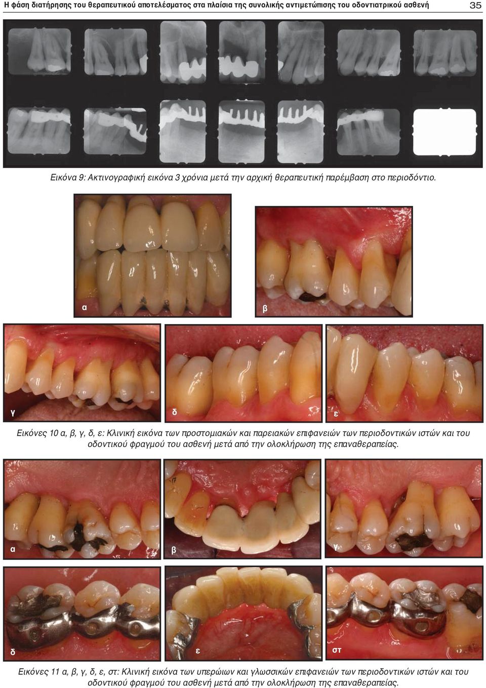 α β γ δ ε Εικόνες 10 α, β, γ, δ, ε: Κλινική εικόνα των προστομιακών και παρειακών επιφανειών των περιοδοντικών ιστών και του οδοντικού φραγμού του
