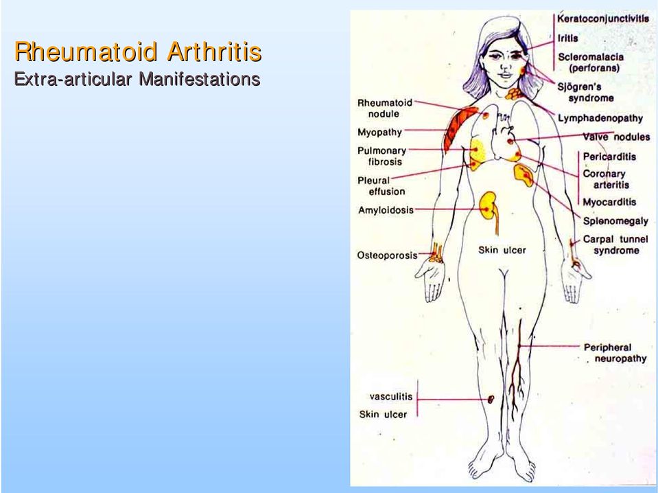 Extra-articular