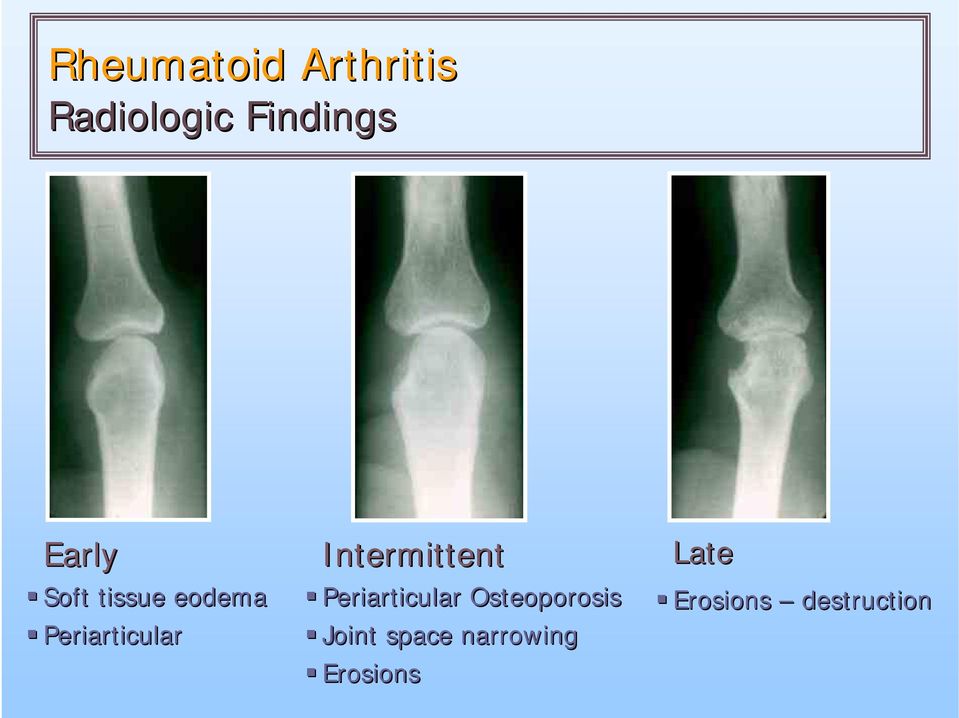 Intermittent Periarticular Osteoporosis