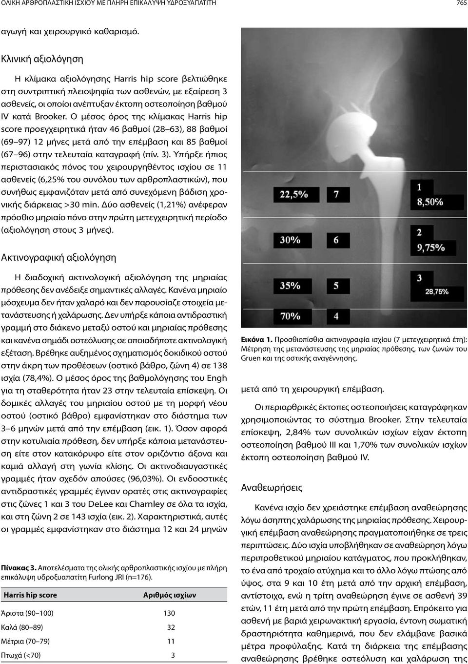 Ο μέσος όρος της κλίμακας Harris hip score προεγχειρητικά ήταν 46 βαθμοί (28 63), 88 βαθμοί (69 97) 12 μήνες μετά από την επέμβαση και 85 βαθμοί (67 96) στην τελευταία καταγραφή (πίν. 3).