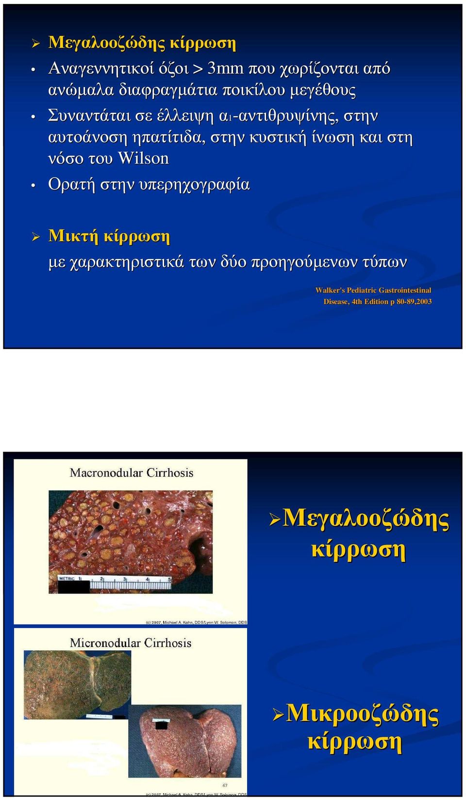 νόσο του Wilson Ορατή στην υπερηχογραφία Μικτή κίρρωση µε χαρακτηριστικά των δύο προηγούµενων τύπων