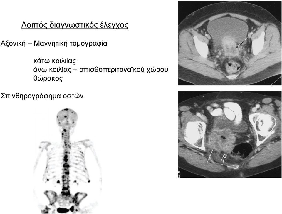 κοιλιίας άνω κοιλίας