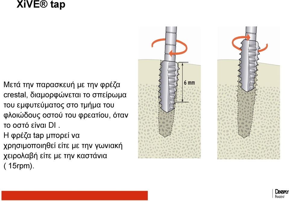 φρεατίου, όταν το οστό είναι DI.