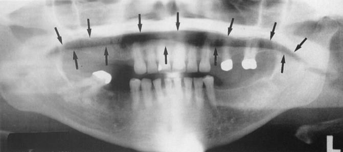 Εάν η γλώσσα δεν τοποθετηθεί στην οροφή του στόματος προκύπτει διαυγαστική λωρίδα στην περιοχή των ριζών των δοντιών της άνω γνάθου (From Haring J, Jansen L: