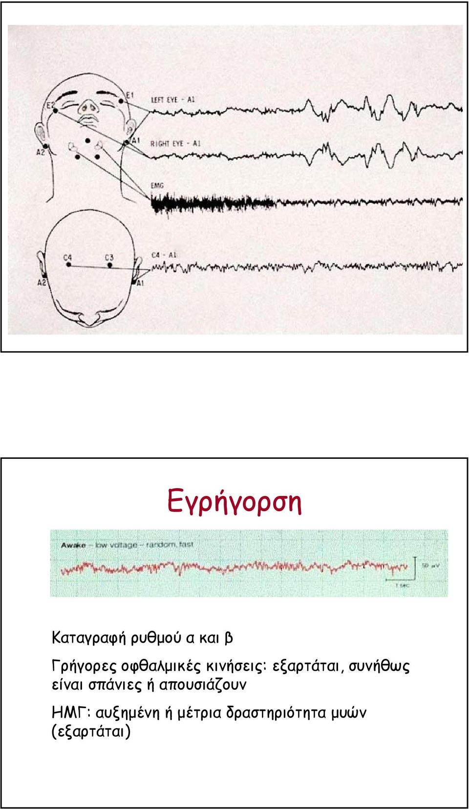 συνήθως είναι σπάνιες ή απουσιάζουν ΗΜΓ: