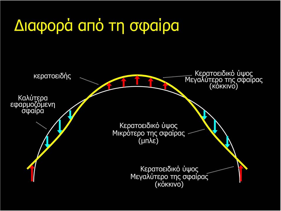 σφαίρας (κόκκινο) Κερατοειδικό ύψος Μικρότερο της