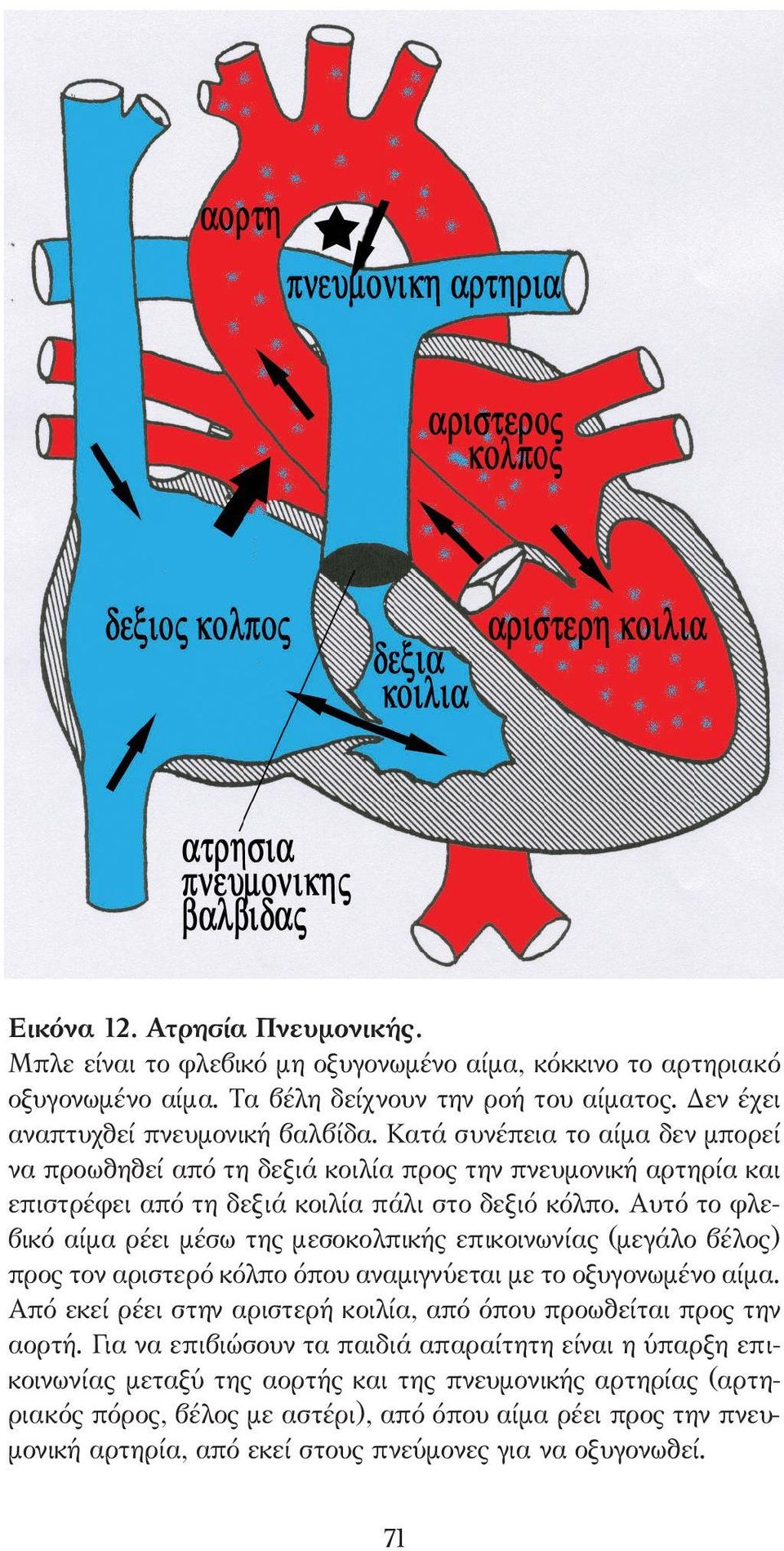 Αυτό το φλεβικό αίµα ρέει µέσω της µεσοκολπικής επικοινωνίας (µεγάλο βέλος) προς τον αριστερό κόλπο όπου αναµιγνύεται µε το οξυγονωµένο αίµα.