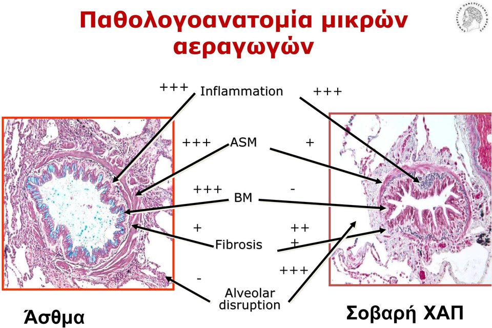 +++ ASM + +++ - BM + ++ Fibrosis