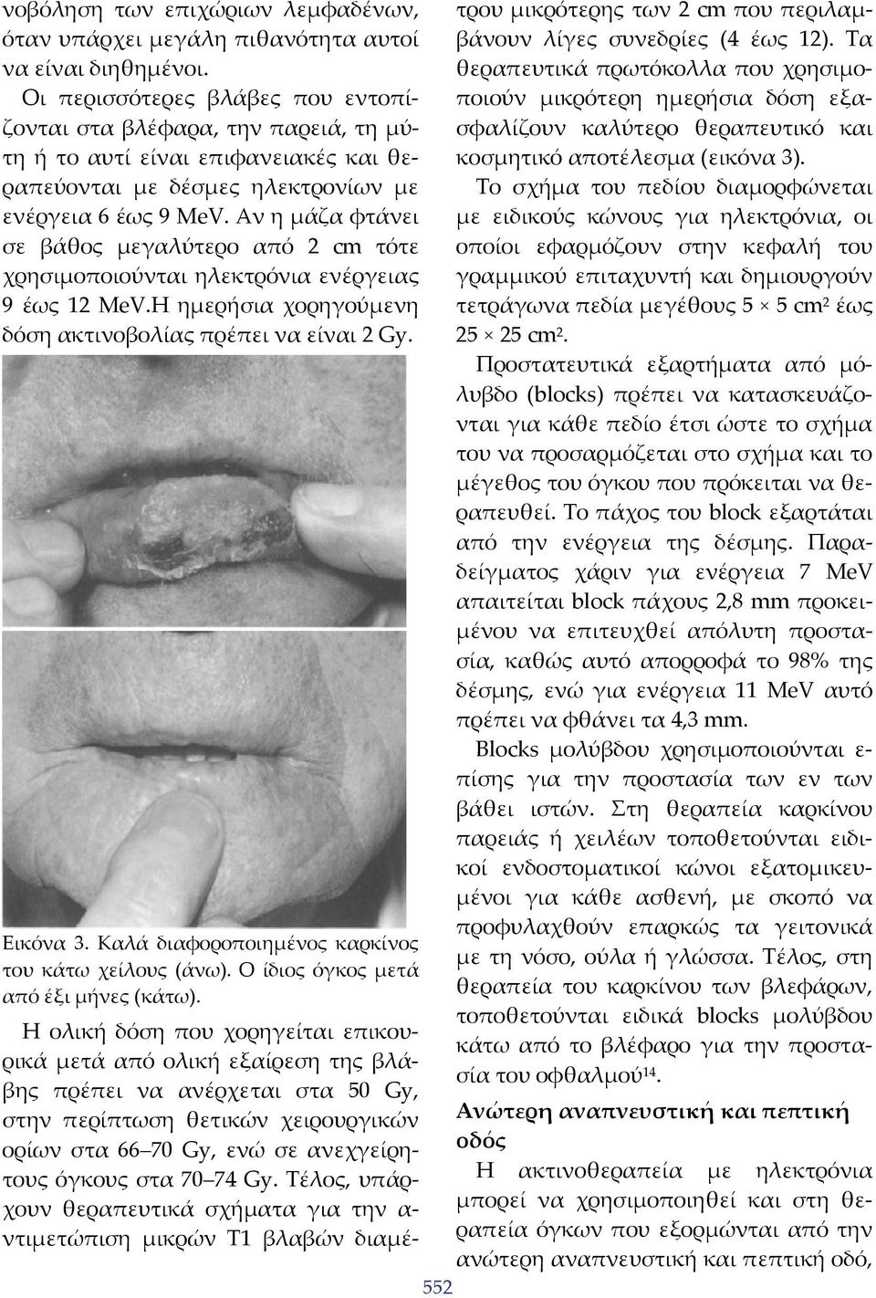 Αν η μάζα φτάνει σε βάθος μεγαλύτερο από 2 cm τότε χρησιμοποιούνται ηλεκτρόνια ενέργειας 9 έως 12 MeV.Η ημερήσια χορηγούμενη δόση ακτινοβολίας πρέπει να είναι 2 Gy. Εικόνα 3.