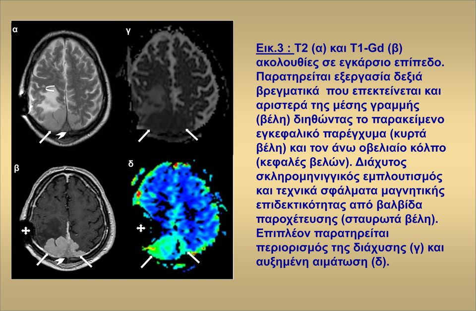 παρακείμενο εγκεφαλικό παρέγχυμα (κυρτά βέλη) και τον άνω οβελιαίο κόλπο (κεφαλές βελών).