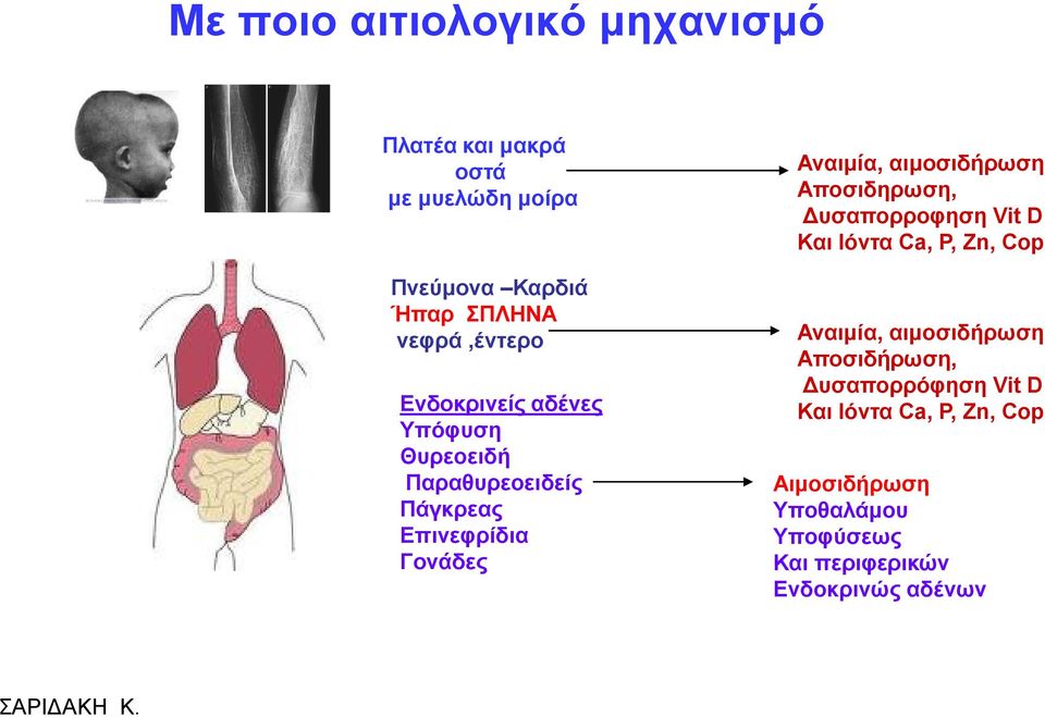 αηκνζηδήξσζε Απνζηδεξσζε, Γπζαπνξξνθεζε Vit D Καη Ιόληα Ca, P, Zn, Cop Αλαηκία, αηκνζηδήξσζε