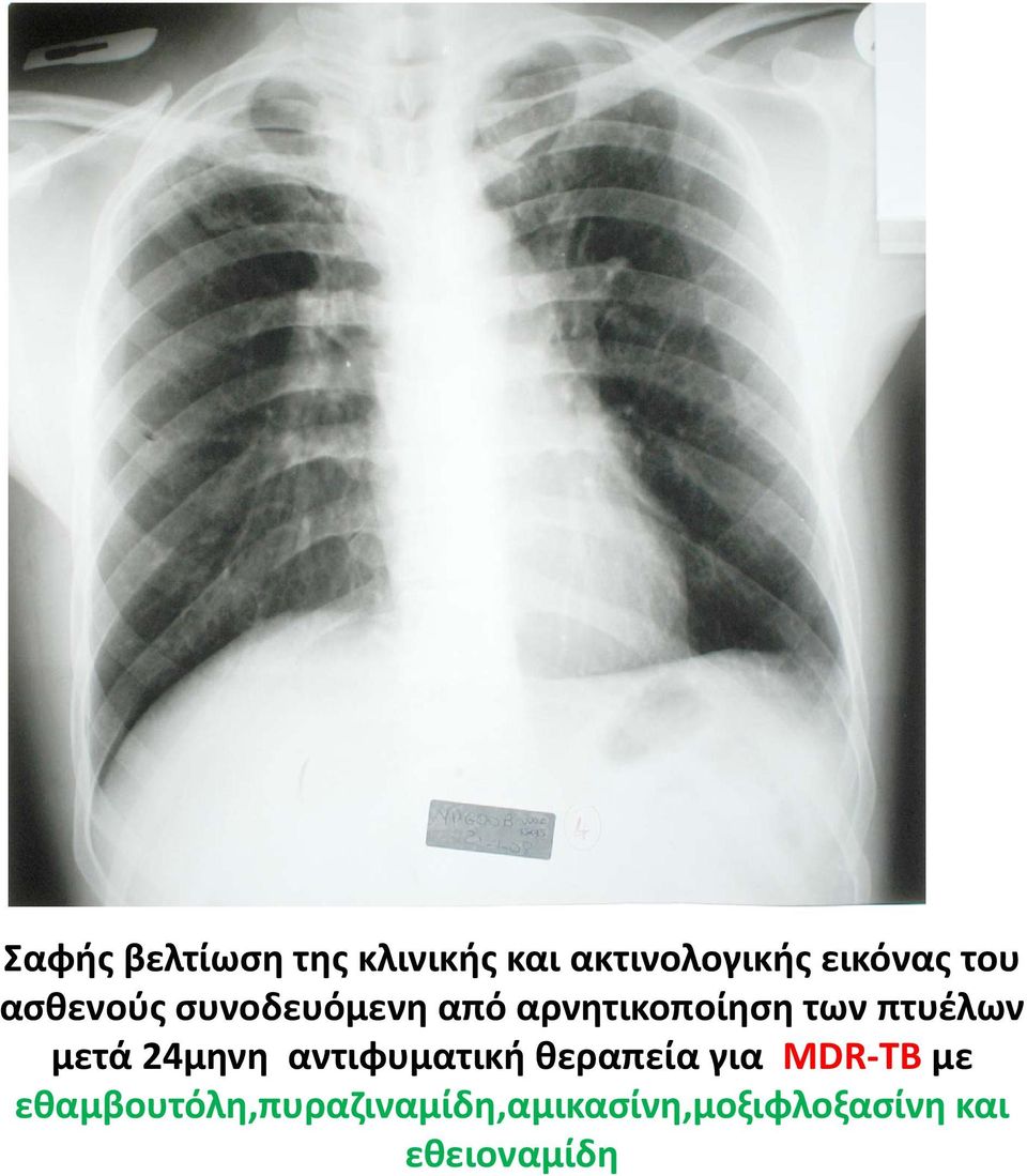 πτυέλων μετά 24μηνη αντιφυματική θεραπεία για MDR TB με