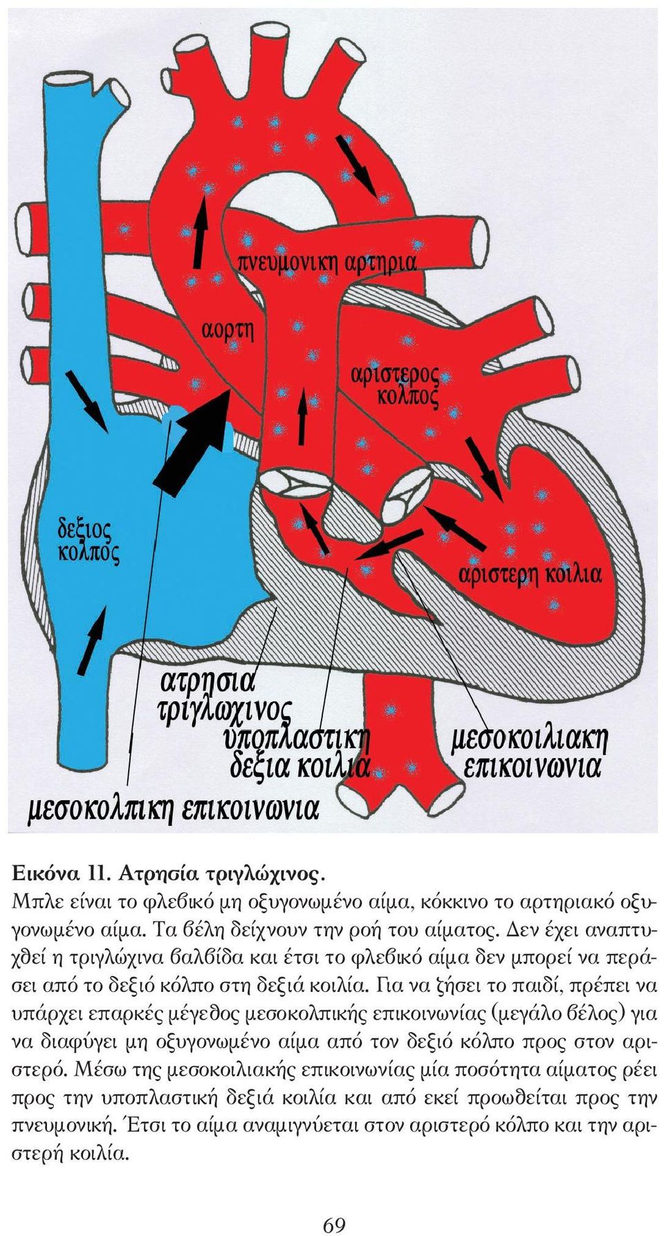 Για να ζήσει το παιδί, πρέπει να υπάρχει επαρκές µέγεθος µεσοκολπικής επικοινωνίας (µεγάλο βέλος) για να διαφύγει µη οξυγονωµένο αίµα από τον δεξιό κόλπο προς στον