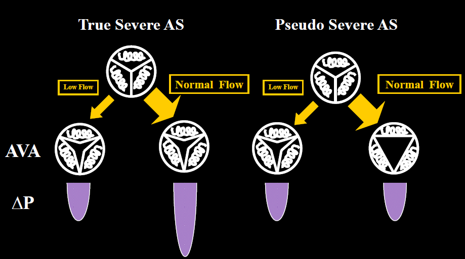 Low flow Low gradient Aortic