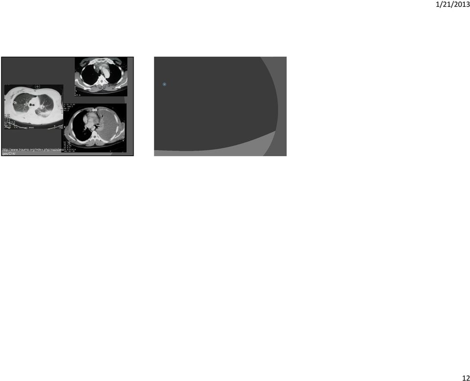 nl/en/46b480 a6e4bdc Πνευμονεκτομή λοβεκτομή http://radiographics.rsna.