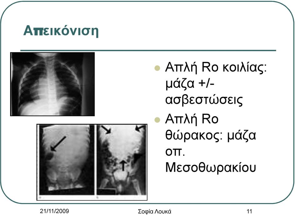 θώρακος: μάζα οπ.
