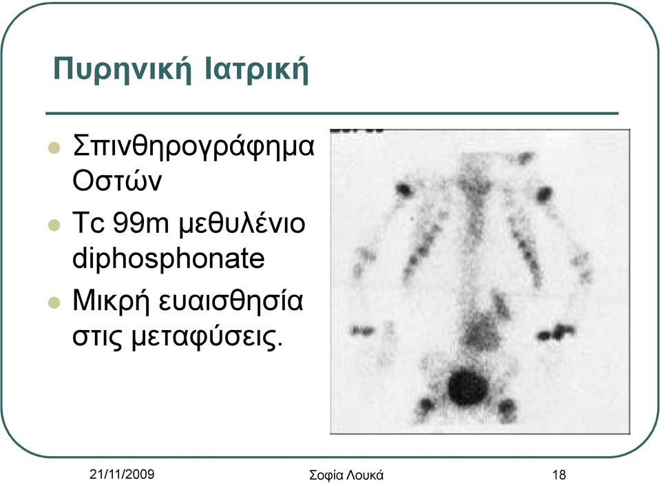 diphosphonate Μικρή ευαισθησία