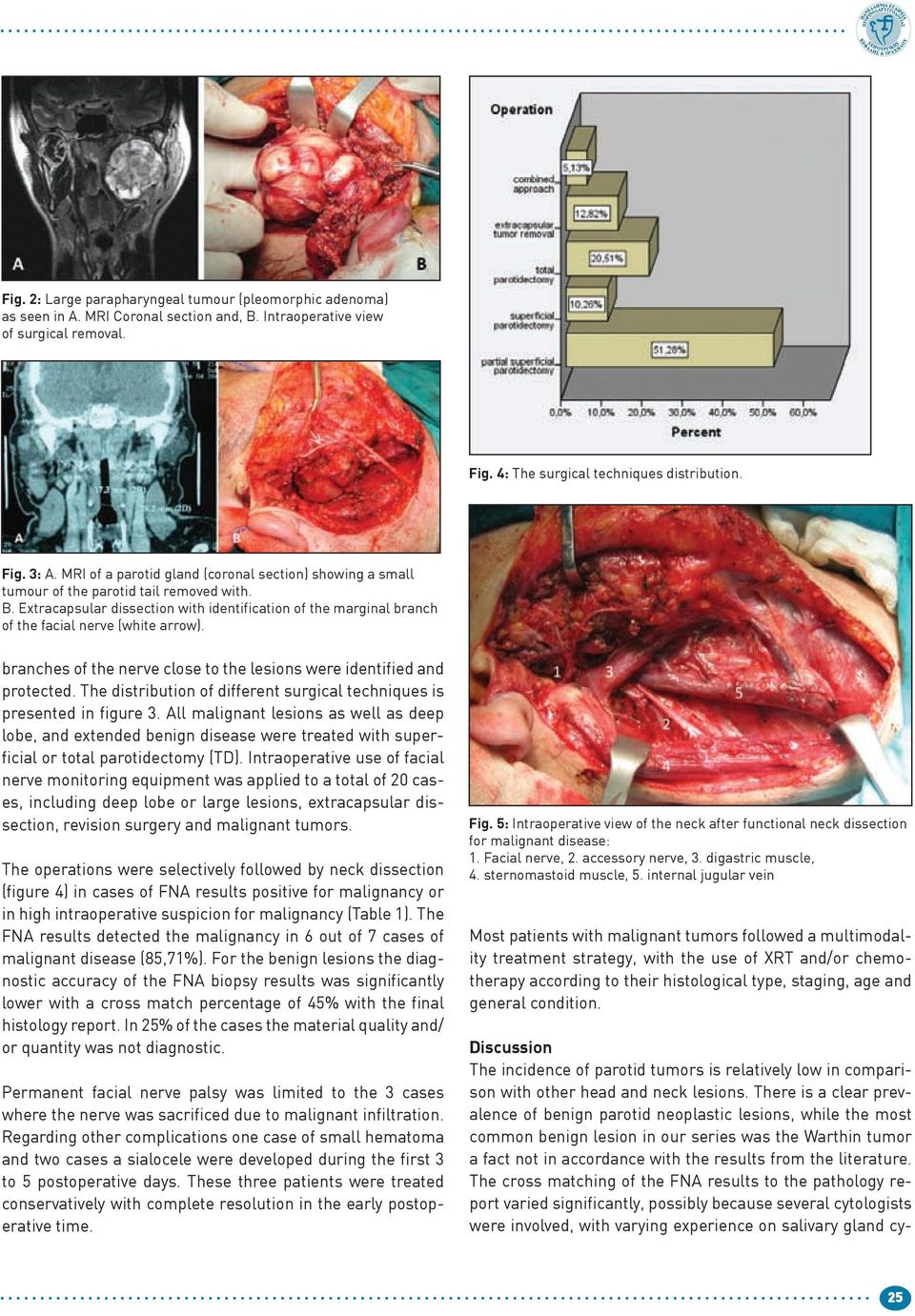 Extracapsular dissection with identification of the marginal branch of the facial nerve (white arrow). branches of the nerve close to the lesions were identified and protected.