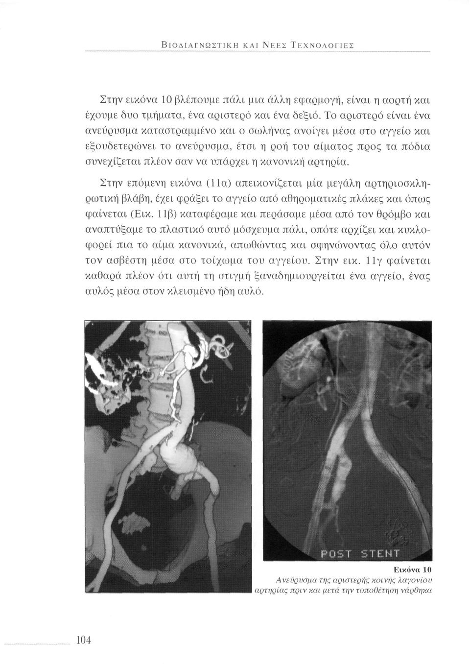αρτηρία. Στην επόμενη εικόνα (11α) απεικονίζεται μία μεγάλη αρτηριοσκληρωτική βλάβη, έχει φράξει το αγγείο από αθηροματικές πλάκες και όπως φαίνεται (Εικ.