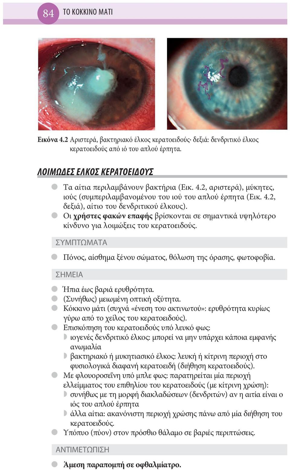 ΣΥΜΠΤΩΜΑΤΑ Πόνος, αίσθημα ξένου σώματος, θόλωση της όρασης, φωτοφοβία. ΣΗΜΕΙΑ Ήπια έως βαριά ερυθρότητα. (Συνήθως) μειωμένη οπτική οξύτητα.