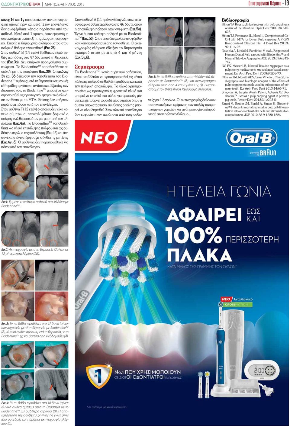 Στον ασθενή Β (14 ετών) βρέθηκαν πολύ βαθιές τερηδόνες στο 47 δόντι κατά τη θεραπεία του (Εικ.3α). Δεν υπήρχαν προηγούμενα συμπτώματα. Το Biodentine TM τοποθετήθηκε σε ολόκληρη την κοιλότητα (Εικ.3β).
