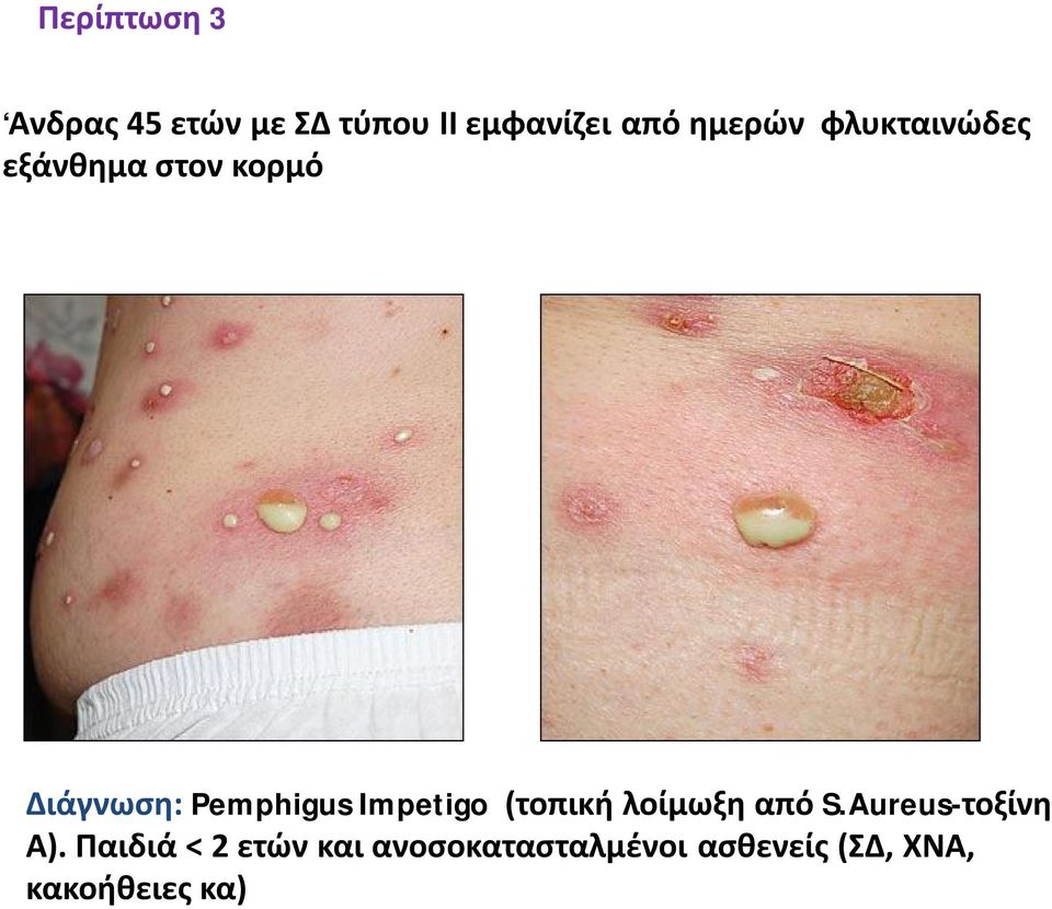 Impetigo (τοπική λοίμωξη από S.Aureus-τοξίνη Α).
