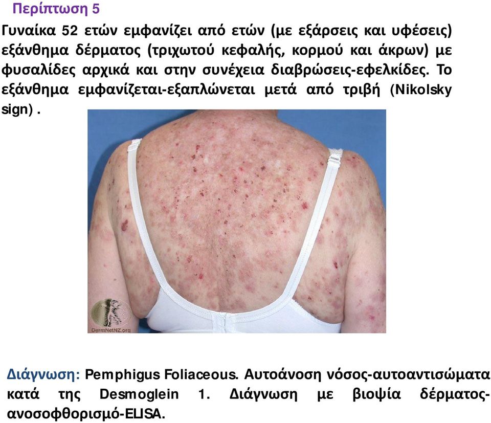 Το εξάνθημα εμφανίζεται-εξαπλώνεται μετά από τριβή (Nikolsky sign).