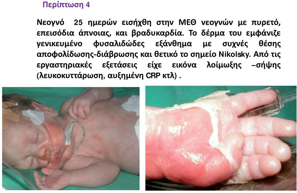 Το δέρμα του εμφάνιζε γενικευμένο φυσαλιδώδες εξάνθημα με συχνές θέσης