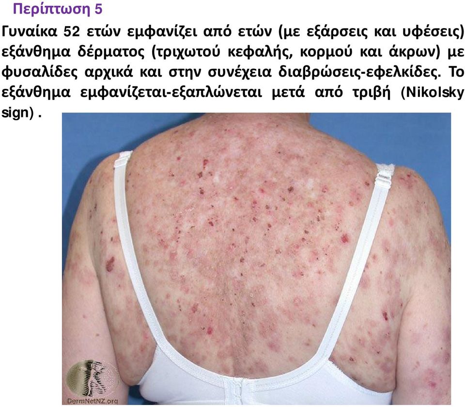 με φυσαλίδες αρχικά και στην συνέχεια διαβρώσεις-εφελκίδες.