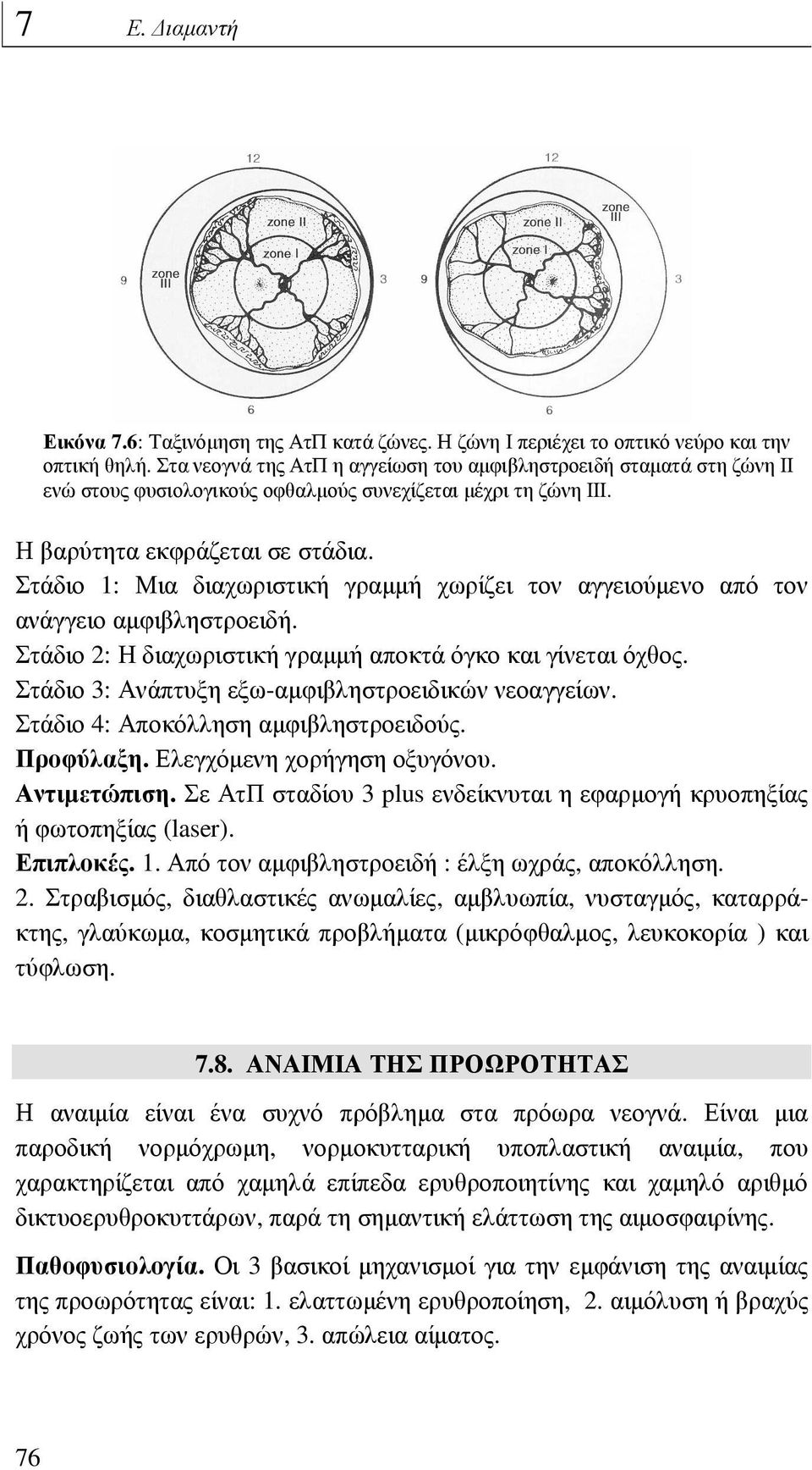 Στάδιο 1: Μια διαχωριστική γραµµή χωρίζει τον αγγειούµενο από τον ανάγγειο αµφιβληστροειδή. Στάδιο 2: Η διαχωριστική γραµµή αποκτά όγκο και γίνεται όχθος.