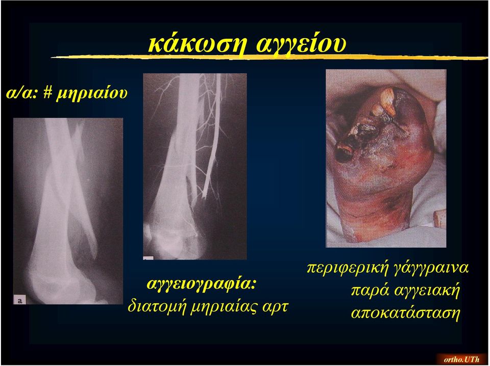 διατομή μηριαίας αρτ