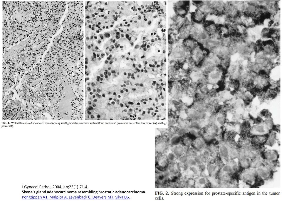 prostatic adenocarcinoma.