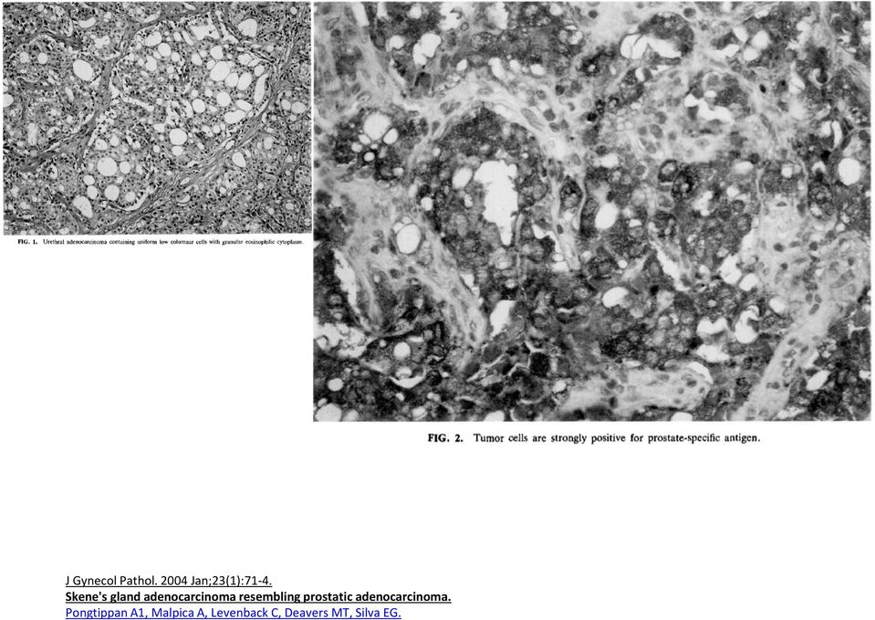 prostatic adenocarcinoma.