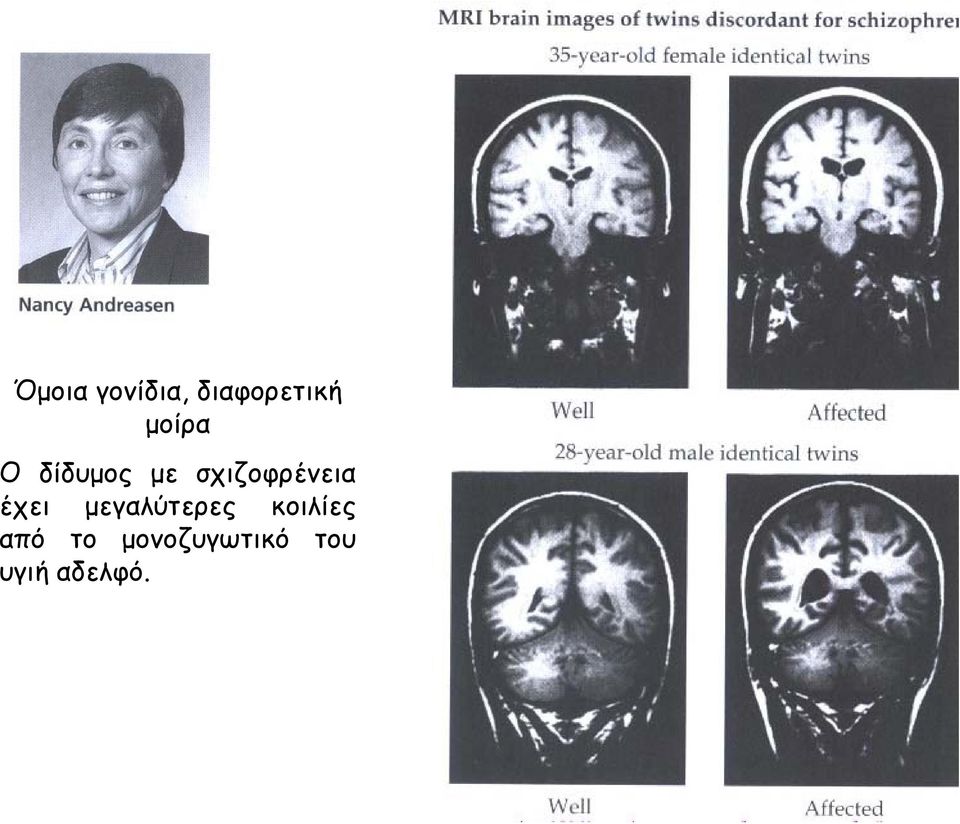 σχιζοφρένεια έχει μεγαλύτερες